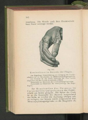 Fig. 102. Enucleationen im Bereiche der Finger.