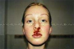 Junge Frau mit Nasenbluten (Sonderthema: Ein Bild von mir - Selbstporträts und Selbstdarstellungen)