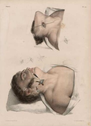 Ligatur der Arteria carotide externa, lingualis, occipitalis und temporalis