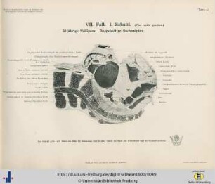 VII. Fall. 30jährige Nullipara. Doppelseitige Sactsalpinx.