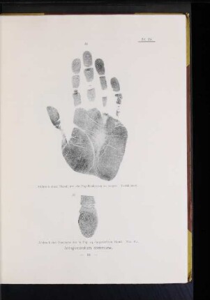 24. Abdruck einer Hand, um die Papillenleisten zu zeigen. Verkleinert.