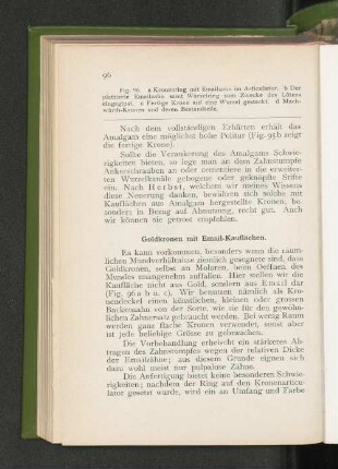 Goldkronen mit Email-Kauflächen.