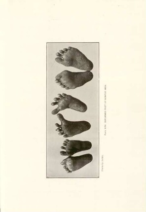Plate XXV. Deformed feet ...