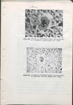 Abb. 7a: Mitose in Sternberg'scher Riesenzelle. E. 2796/48. Abb. 7b: Mitose in Sternberg'scher Riesenzelle. E. 2862/48.