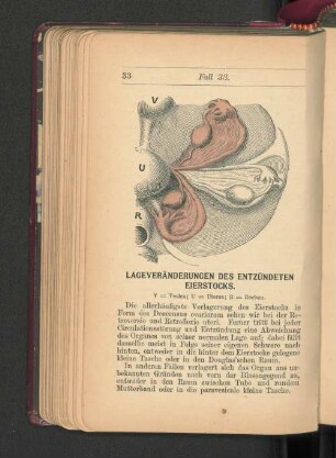 Lageveränderungen des entzündeten Eierstocks.