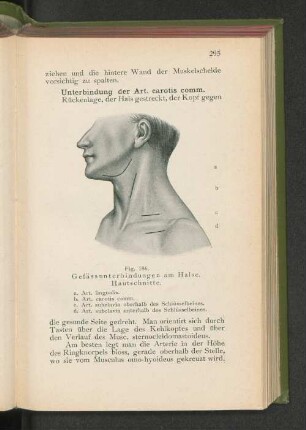 Fig. 186. Gefässunterbindung am Halse.