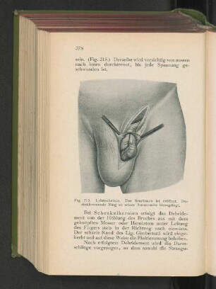 Fig. 215. Leistenhernie. Der Bruchsack ist eröffnet. Der einklemmende Ring an seiner Aussenseite blossgelegt.
