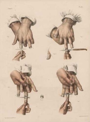 Amputationen an der Hand