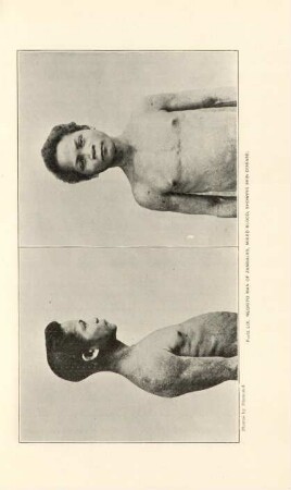 Plate LIX.Negrito Man of Zambales, mixed blood, showing skin disease