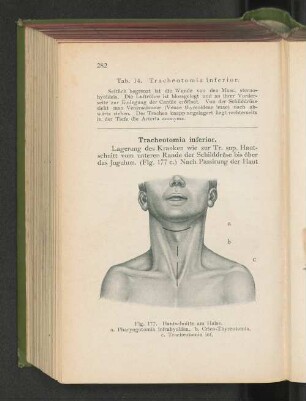 Tracheotomia inferior.
