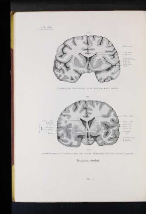 179 Frontalschnitt des Gehirns durch das Caput nuclei caudati.