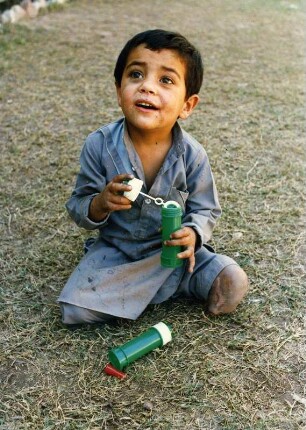 Afghanisches Kind verkrüppelt : Durch eine sowjetische Spielzeugbombe verkrüppeltes afghanisches Kind, aufgenommen 1986 in einem Flüchtlingslager in Pakistan