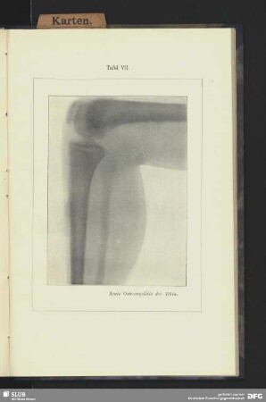 Tafel VII. Acute Osteomyelitis der Tibia