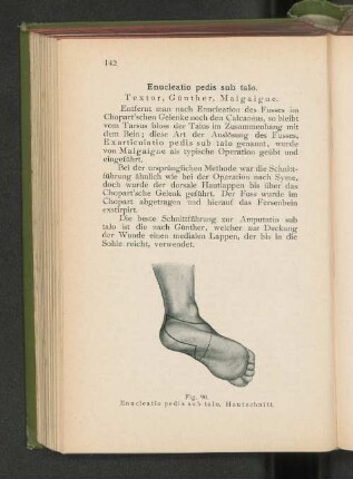 Enucleatio pedis sub talo.