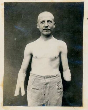 Foto eines Mannes mit amputierten Armen im Kngl. Reservelazarett in Singen