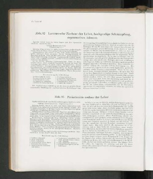 Abb. 92 Laennesche Zirrhose der Leber, hochgradige Schrumpfung, regeneratives Adenom