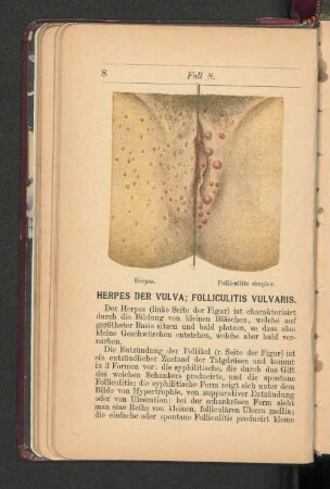 Herpes der Vulva; Folliculitis Vulvaris.