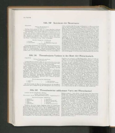 Abb. 180 Karzinom der Brustwarze
