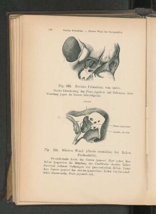Fig. 134. Hintere Wand (Paries mastoidea) der linken Paukenhöhle.