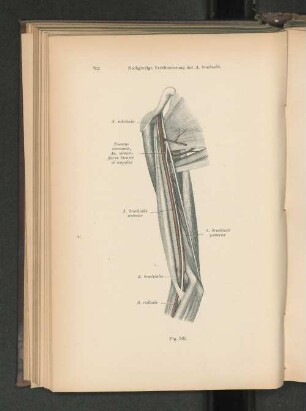 Fig. 560. Hochgradige Verkümmerung der A. brachialis.