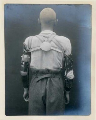 Foto der Rückansicht eines an beiden Armen amputierten Mannes mit doppelter Armprothese im Kngl. Reservelazarett in Singen