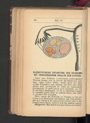 Kleincystische Entartung des Ovariums mit verschiedenem Inhalte der Cysten.