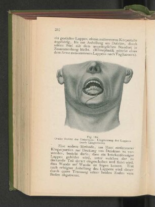 Fig. 154. Ovaler Defekt der Unterlippe. Umgrenzung des Lappens (nach Langenbeck).