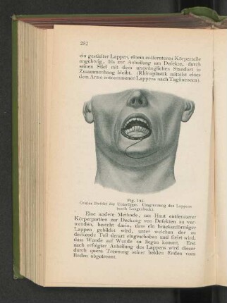 Fig. 154. Ovaler Defekt der Unterlippe. Umgrenzung des Lappens (nach Langenbeck).