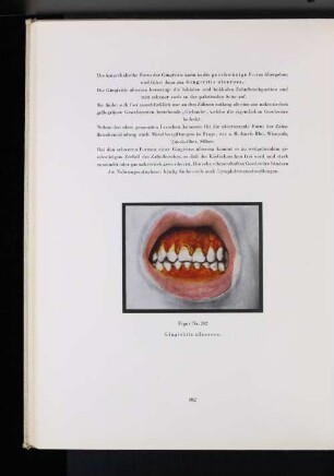 Figur Nr. 202 Gingivitis ulcerosa.