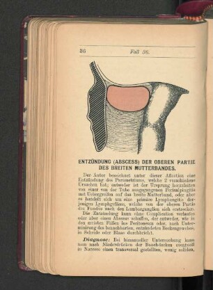 Entzündung der oberen Partie des breiten Mutterbandes.