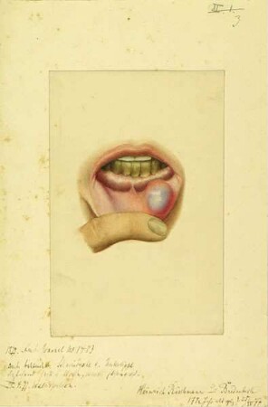 Schleimcyste d. Unterlippe. Krankenbildnis Heinrich Rüschmann