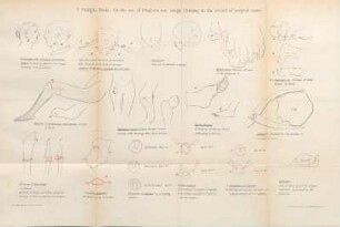 T. Pridgin Teale, On the use of Diagram and rough Drawing in the record of surgical cases.