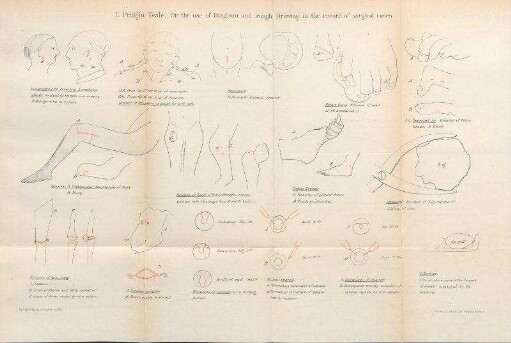 T. Pridgin Teale, On the use of Diagram and rough Drawing in the record of surgical cases.