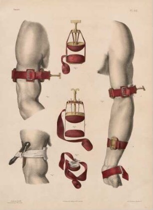 Die Verengung von Arterien am Arm