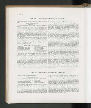 Abb. 58 Chronische tuberkulöse Pleuritis