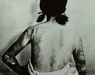 Nagasaki. Bindegewebige Hautgeschwülste (Keloide) als Spätfolge von Verbrennungen durch die Atombombenexplosion