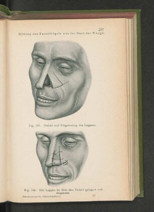 Fig. 160. Der Lappen ist über den Defekt gelagert und eingenäht.