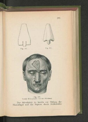 Fig. 158. Totale Rhinoplastik aus der Stirnhaut.