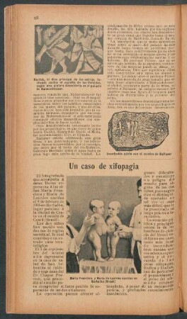 Un caso de xifopagia