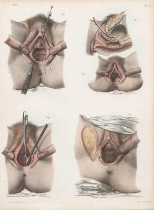 Die Vernähung und Behandlung vaginaler Fisteln