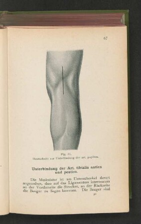 Unterbindung der Art. tibialis antica und postica.