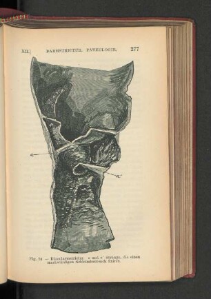 Fig. 53. - Dünndarmstrictur.