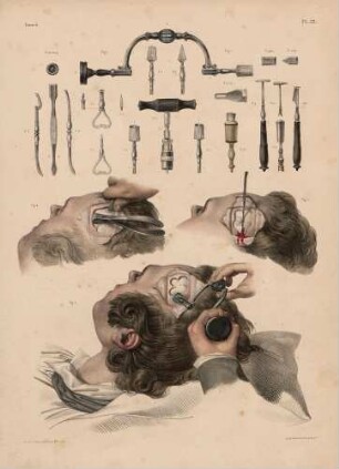 Die Trepanation des Schädels und die dazu benötigten Instrumente