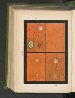 Fig. 47. Erkrankung der Macula lutea der Netzhaut infolge hohen Alters - senile Maculaerkrankung.