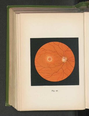 Fig. 49. Lochbildung in der macula lutea durch Kontusion des Augapfels.
