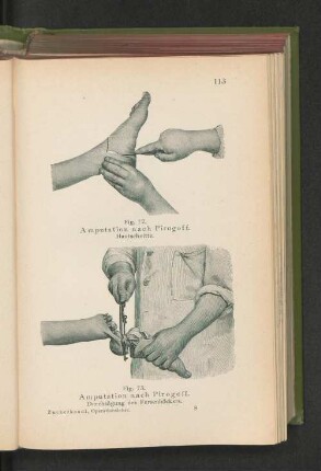 Fig. 73. Amputation nach Pirogoff. Durchsägung des Fersenhöckers.