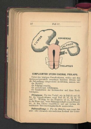 Complicirter Utero-Vaginal Prolaps.