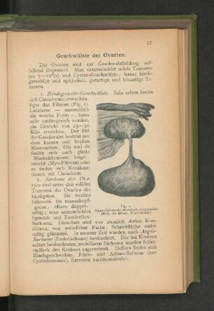 Geschwülste der Ovarien.