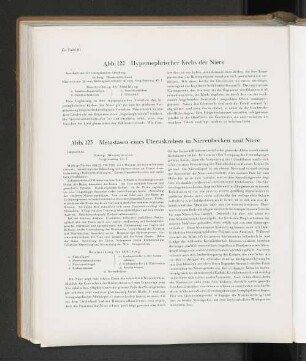 Abb. 122 Hypernephrischer Krebs der Niere
