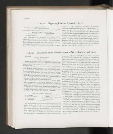 Abb. 122 Hypernephrischer Krebs der Niere
